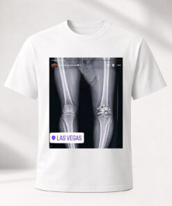 Unisex Funny Conor McGregor X Ray Broken Knee Graphic Shirt for MMA Fans
